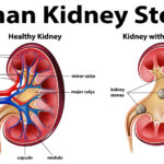 Avoid Kidney Stones – Stay Hydrated!