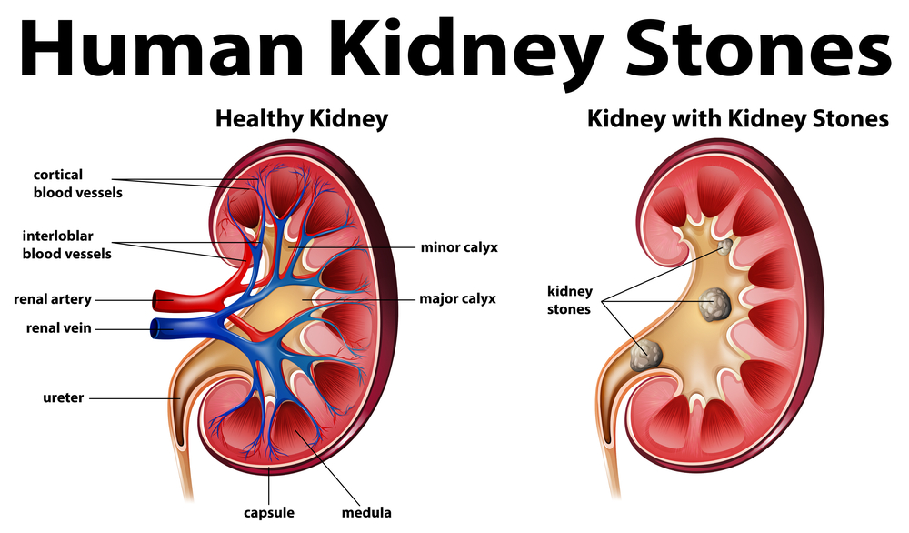 Avoid Kidney Stones - Stay Hydrated!