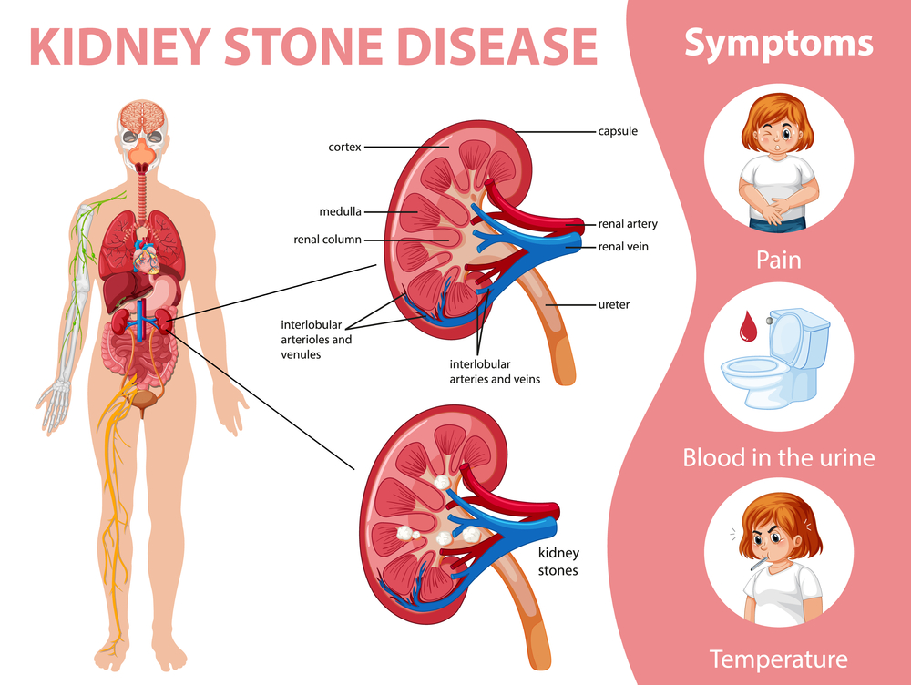 Kidney stones disease and symptoms infographic